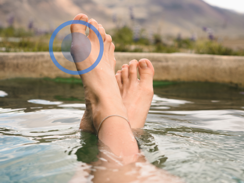 Hallux valgus czyli paluch koślawy