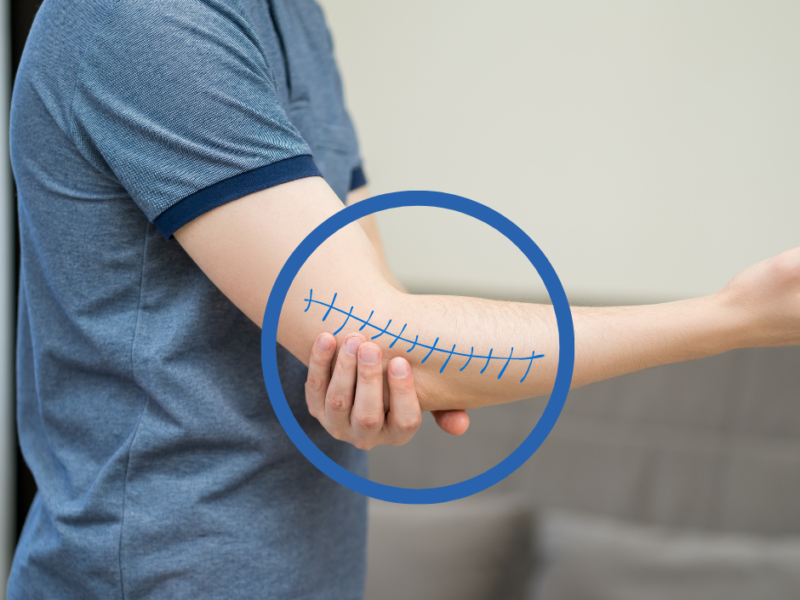 Fizjoterapia po&nbsp;endoprotezie łokcia