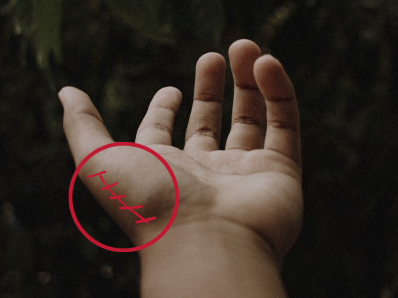 Zespół de&nbsp;Quervaina – fizjoterapia po&nbsp;operacji