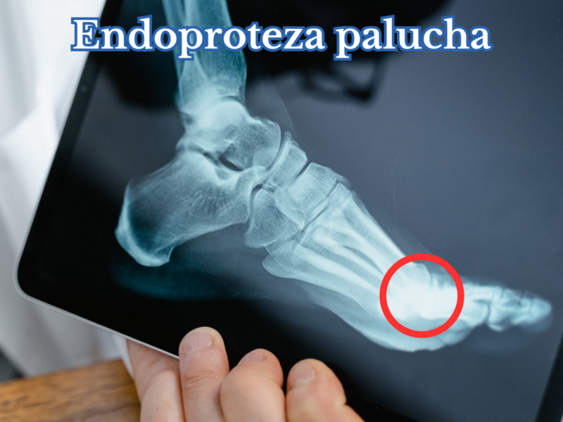 Endoproteza palucha fizjoterapia