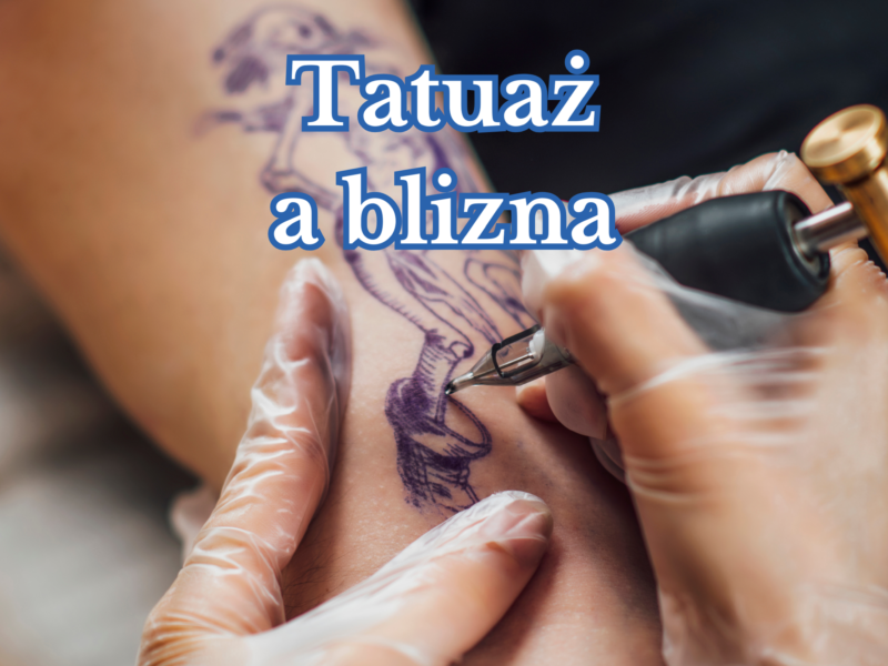 Tatuaż a&nbsp;blizna